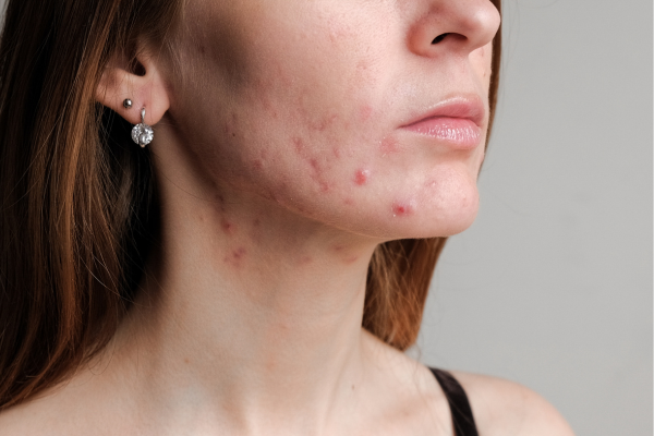 DV Clinic Medicina Estetica: Acne E Cicatrici Da Acne